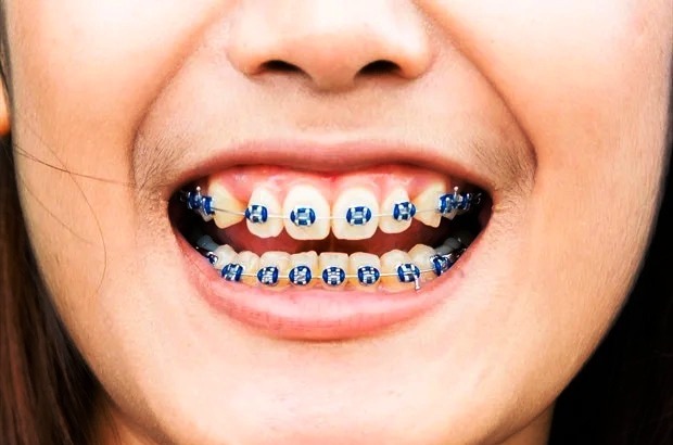 Orthodontics & Aligners