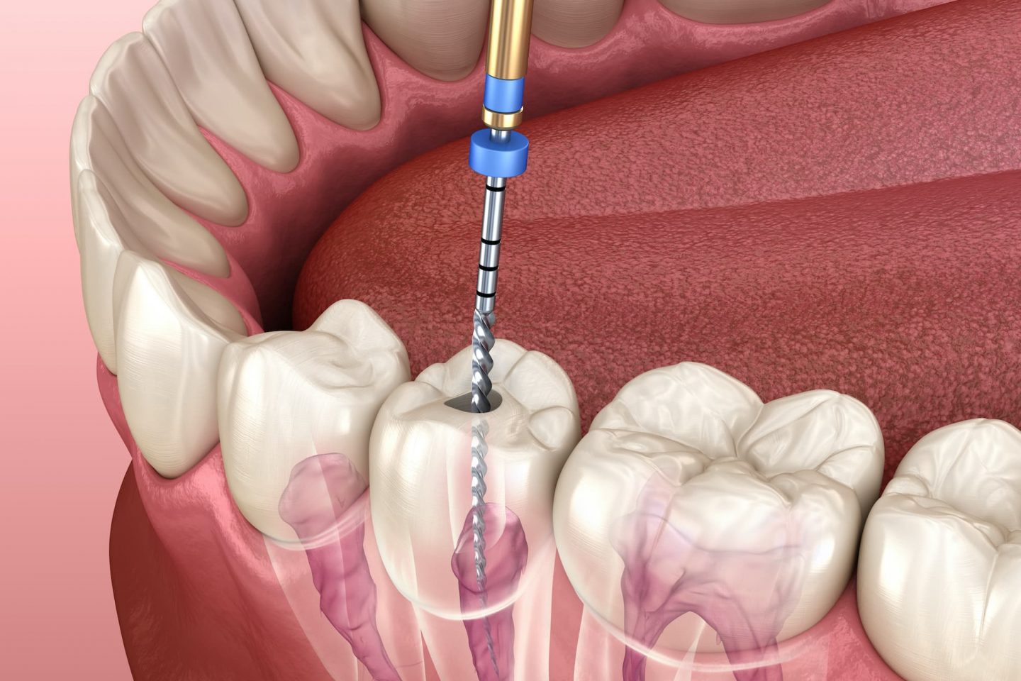 Root Canal Care